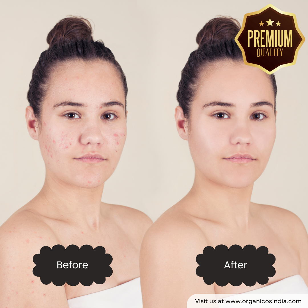 Anti Acne Tea Facial Tree Mask