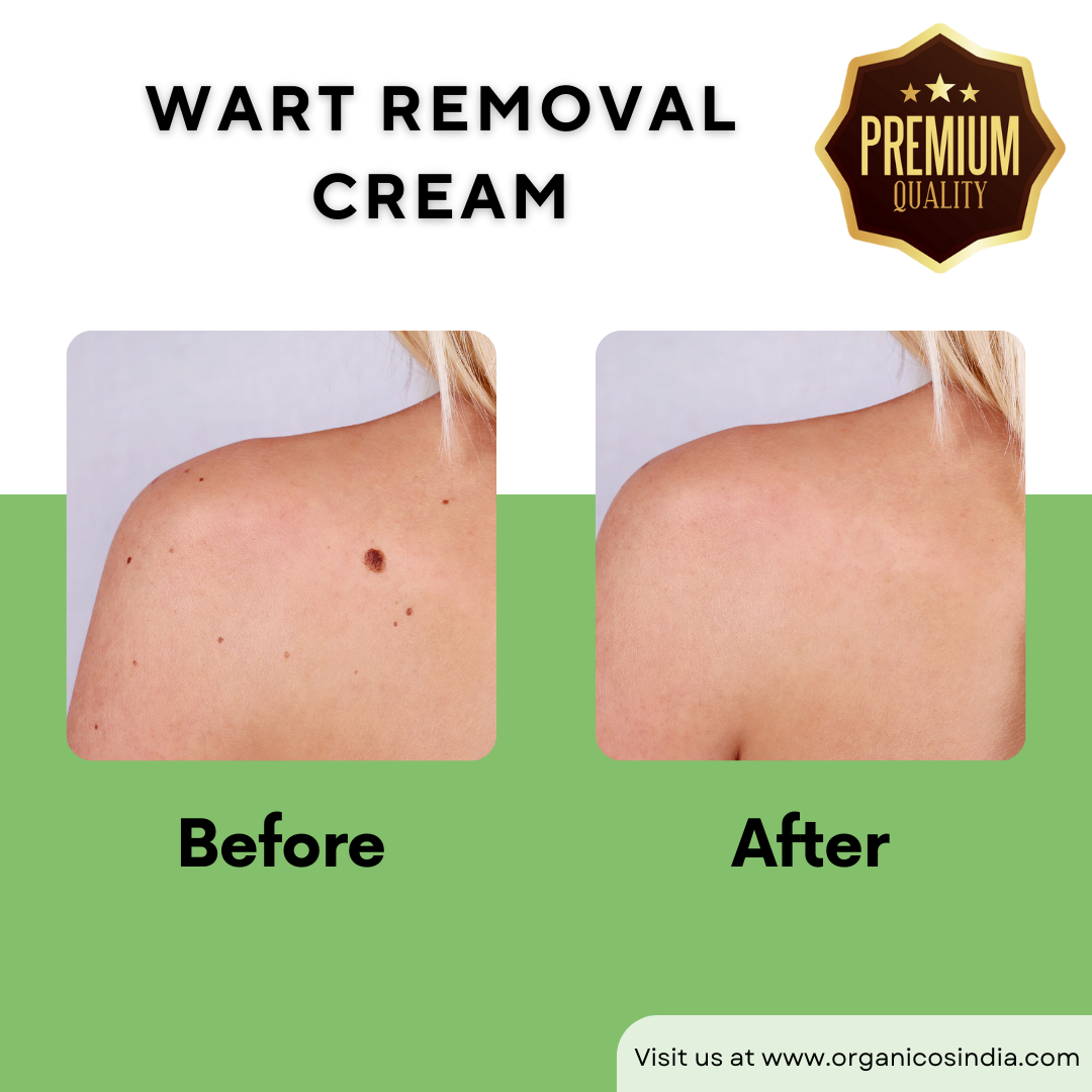 Wart Removal Cream